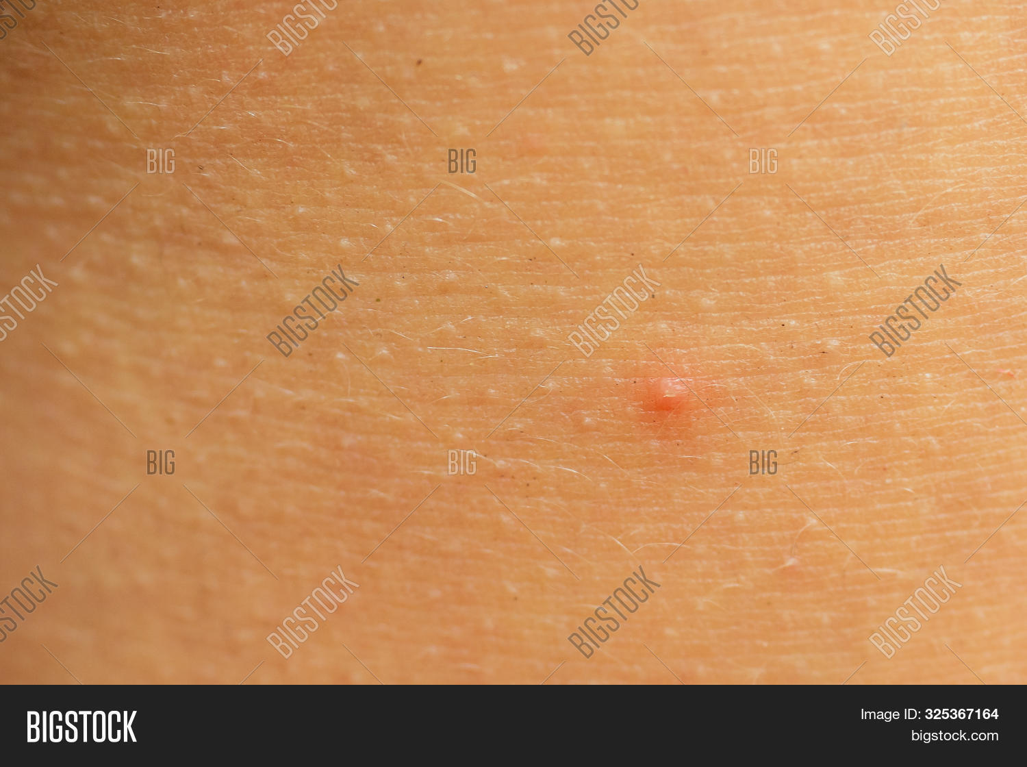 Postacne, Scars Red Image & Photo (Free Trial) Bigstock