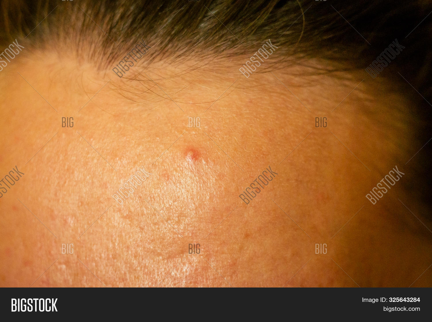 Postacne, Scars Red Image & Photo (Free Trial) Bigstock