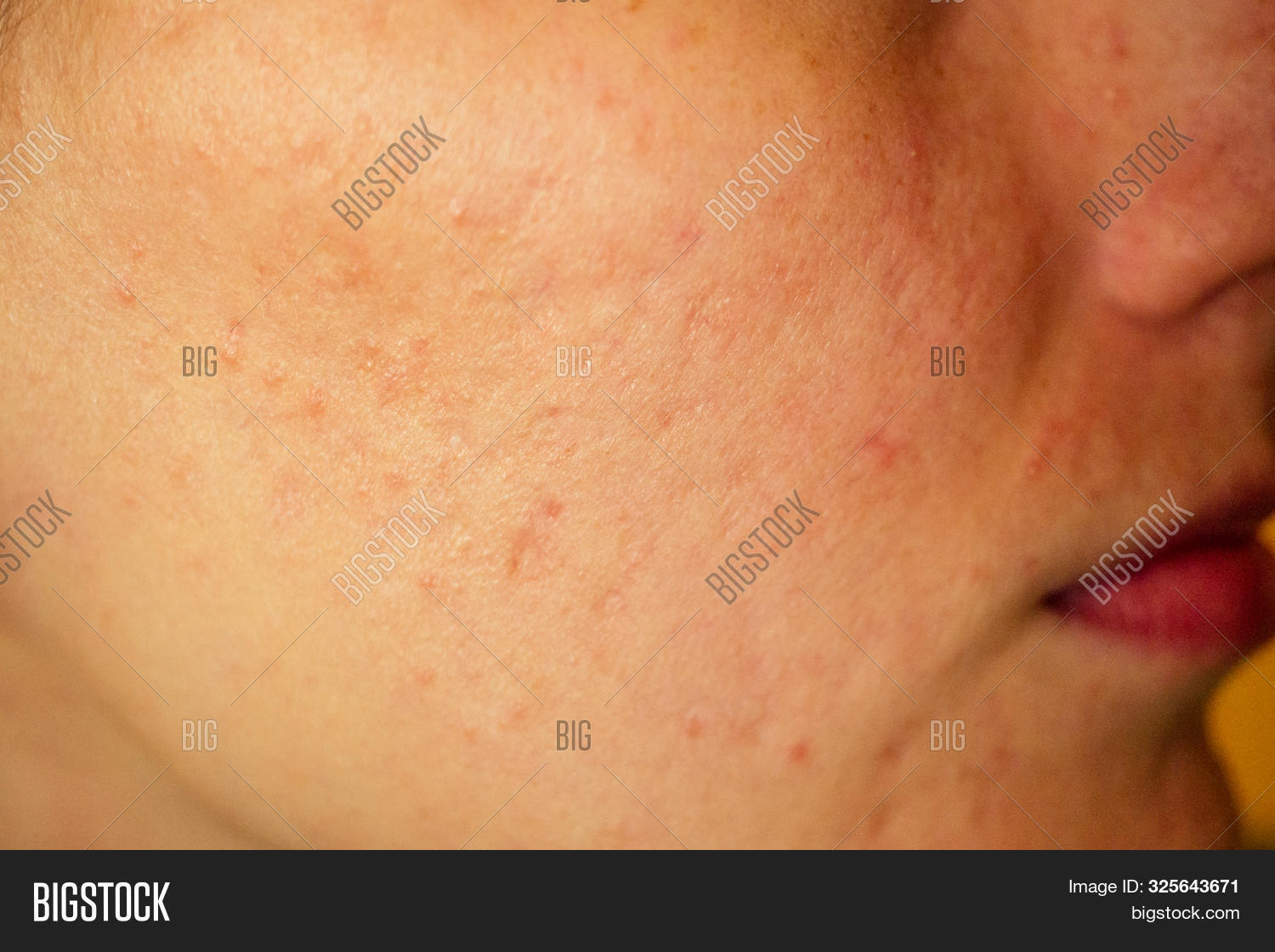Postacne, Scars Red Image & Photo (Free Trial) Bigstock