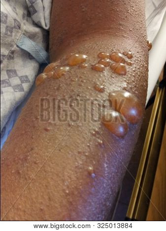 Bullous Pemphigoid Thick Walled Blisters With Clear Fluid