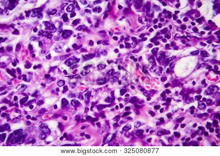 Gastric Adenocarcinoma, Light Micrograph, Photo Under Microscope. High Magnification