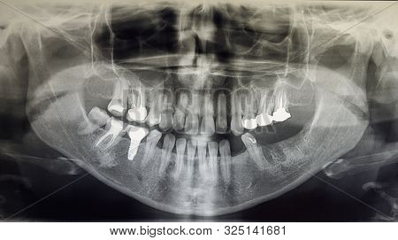 X-ray Panoramic Of An Adult Patient With Previous Dental Care