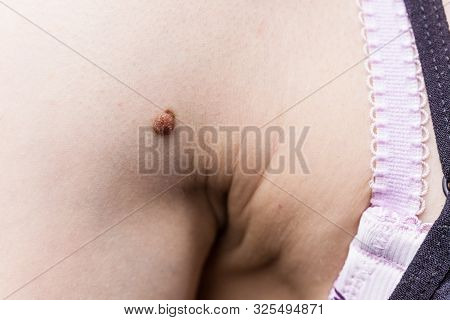 Unrecognizable Person Having Dark Fibroma, Dermatology Problem On Skin. Close Up Of Papilloma Dermat