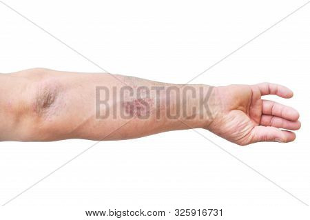 Atopic Dermatitis (ad), Also Known As Atopic Eczema, Is A Type Of Skin Inflammation (dermatitis).ecz