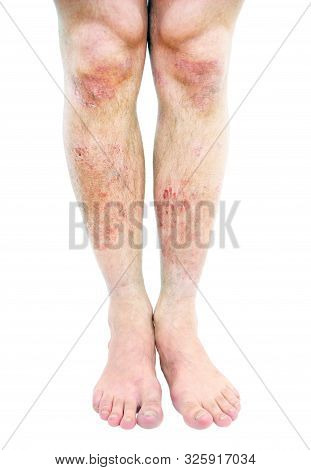 Atopic Dermatitis (ad), Also Known As Atopic Eczema, Is A Type Of Skin Inflammation (dermatitis).ecz