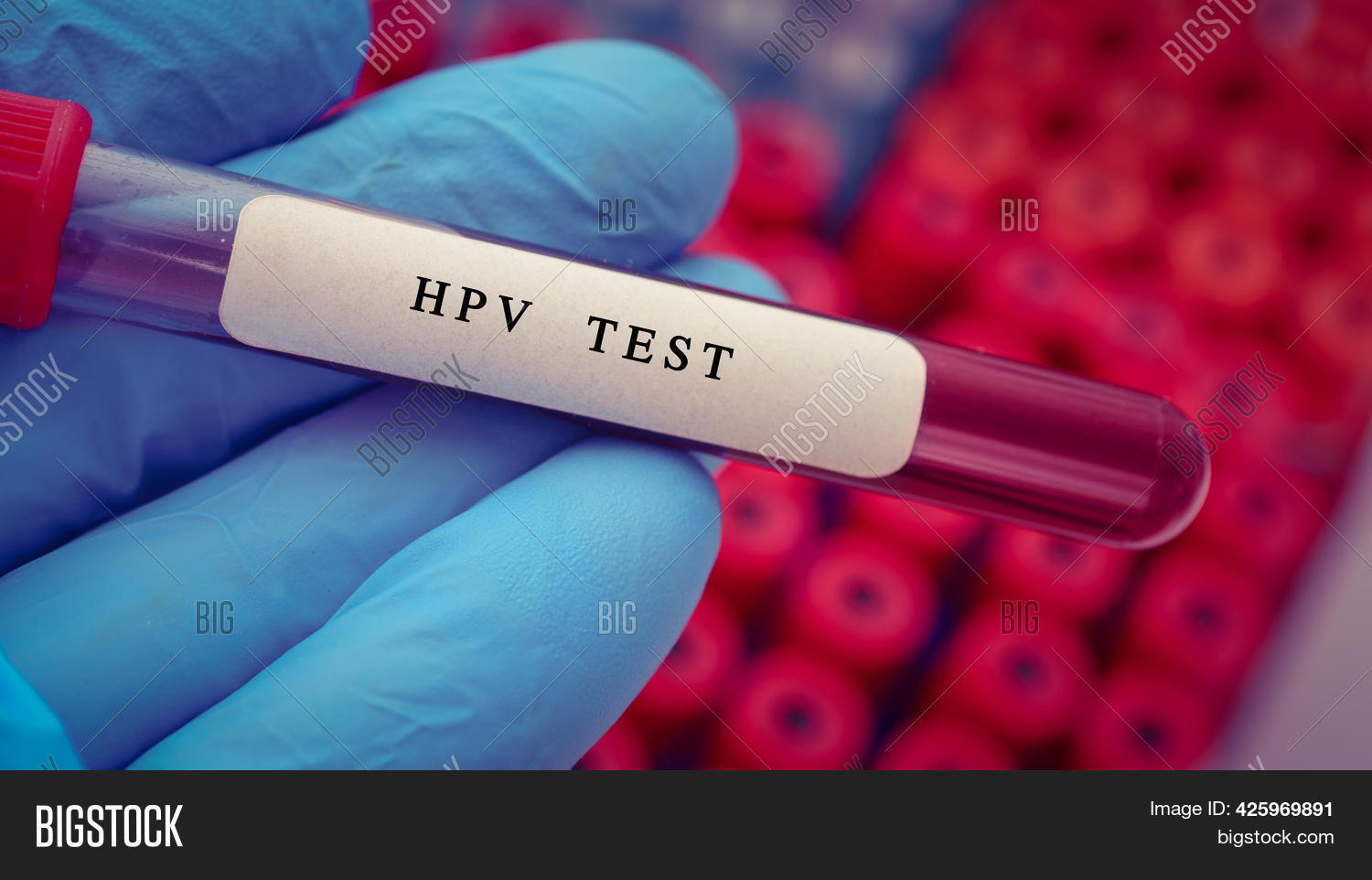 HPV Test Result Blood Image & Photo (Free Trial) Bigstock