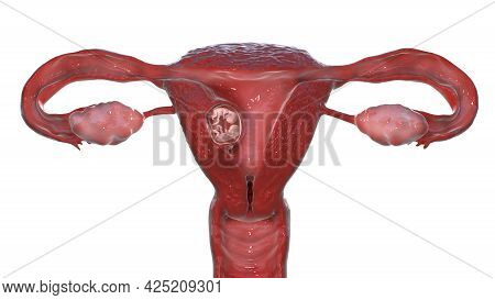 Monozygotic Twins In Uterus With Single Placenta, 3d Illustration. Early Fetal Period, Week 8 - Week