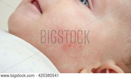 Closeup Of Baby Face With Red Skin Suffering From Acne And Dermatitis. Concept Of Newborn Baby Hygie