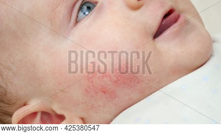 Closeup Of Baby Face Skin With Pimples And Acne From Dermatitis. Concept Of Newborn Baby Hygiene, He