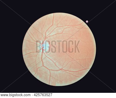 Right Eye's Retinal Image Isolated On A Black Background. A Normal Human Retina.