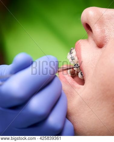 Close Up Of Dentist Hand Using Dental Forceps While Putting Orthodontic Braces On Female Patient Tee