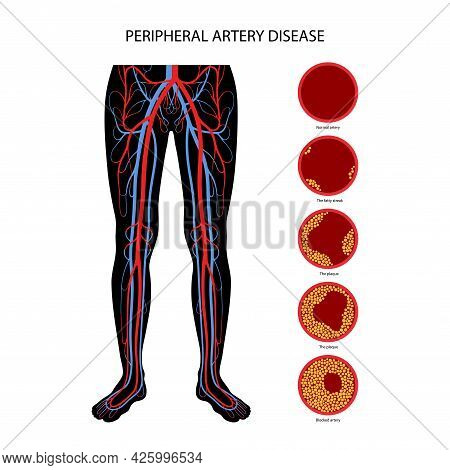 Peripheral Artery Disease. Ischemia In Leg. Cholesterol In Human Blood Vessel. Pad Concept. Fat Cell