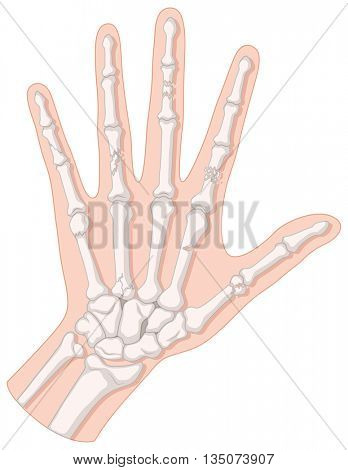 Close up diagram of hand fracture