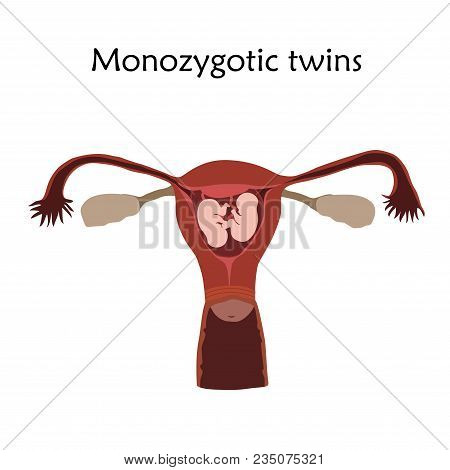 Multiple Pregnancy. Monozygotic Twins, Embryo, Fetus In Uterus, Placenta, Umbilical Cord. Vector Fla