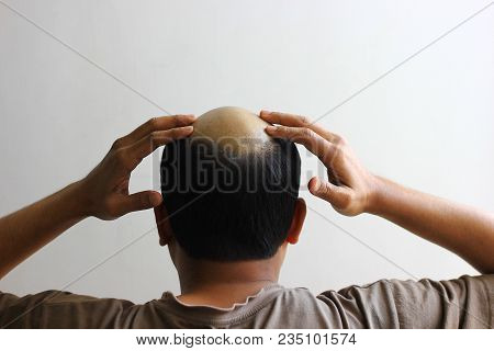 Bald Man In Isolated White Background Worried And Both Hands On His Scalp.view From Behind