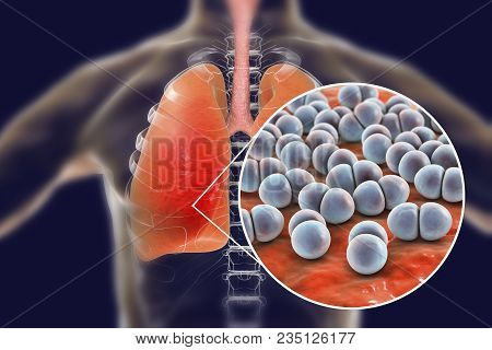 Pneumococcal Pneumonia, Medical Concept. 3d Illustration Showing Bacteria Streptococcus Pneumoniae I