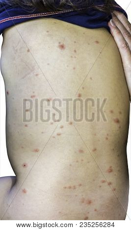 Varicella Virus Or Chicken Pox On Babys Back.