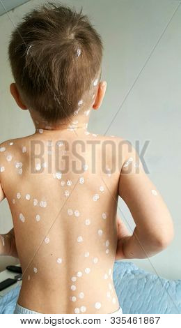 Chicken Pox Rash On Body Boy. Little Boy Ill With Chickenpox At Home. Varicella Virus Or Chickenpox 