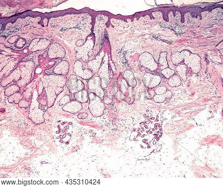 Low Magnification Micrograph Showing The Different Location Of The Sebaceous Glands (more Superficia