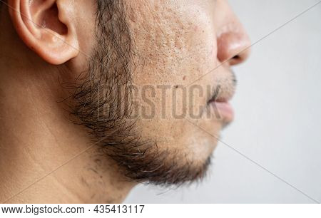 Side View Of Asian Man Face With Beard Grows On A Part Of Lower Face. Beard Is The Collection Of Hai