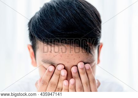 Asian Teenage Boy, Covering His Face With Both Hands, Because Embarrassed By Acne And Acne Scars On 