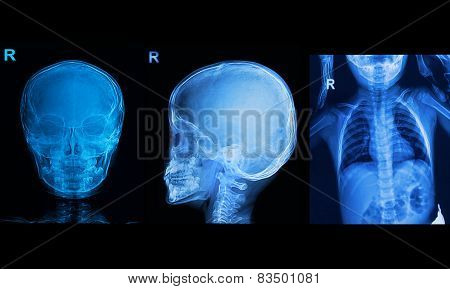 Collection Of Children X-rays  Image Show Skull And Chest Image