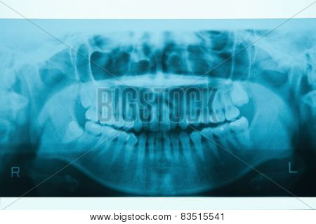 Panoramic Dental X-ray For Orthodontics And Jaw Orthopedics