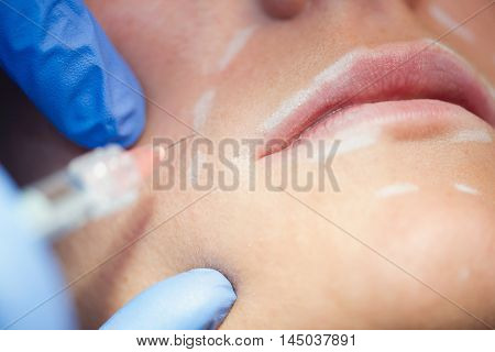 Hyaluronan injection filling facial wrinkles, close up, horizontal image