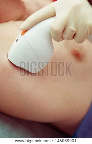 man receiving laser epilation at armpit on beauty center