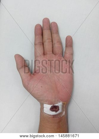 MALACCA, MALAYSIA -MARCH 09, 2016: Left wrist injury and was treated. There were traces of blood on the bandage