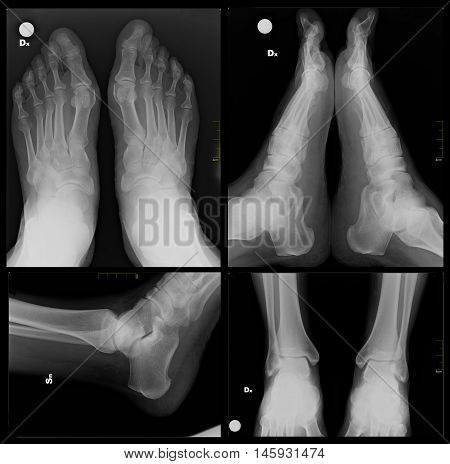 X-ray foot, internal radiology and orthopedic in negative