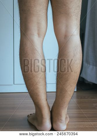 Asian Man Leg Bandy-legged Shape Of The Legs