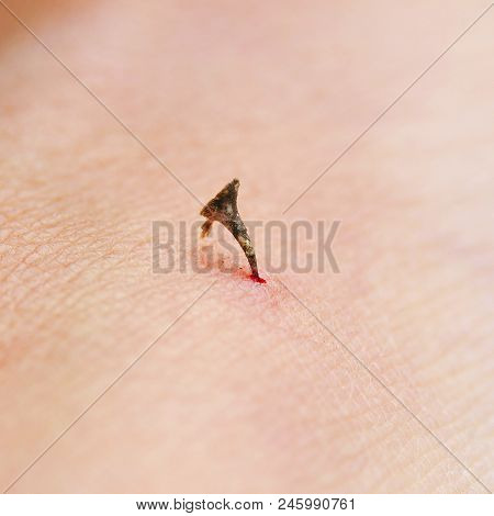 Dirty And Strongly Acute A Sharp Thorn Plants Pierced Skin Human