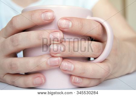 Many White Spots On Fingernails (leukonychia) Due To Calcium Deficit Or Stress. Female Hands Holding