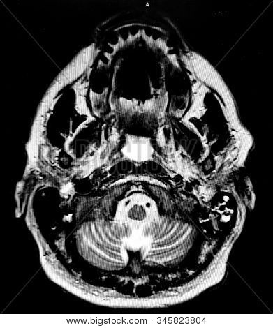 Cerebellum On Brain Ct With Bird-like Appearance
