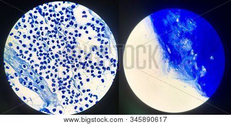 Different Sputum Smear For Detected Mycobacterium Tuberculosis.left Negative Right Positive 3+.