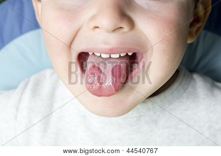 Geografické jazyk onemocnění u dětí