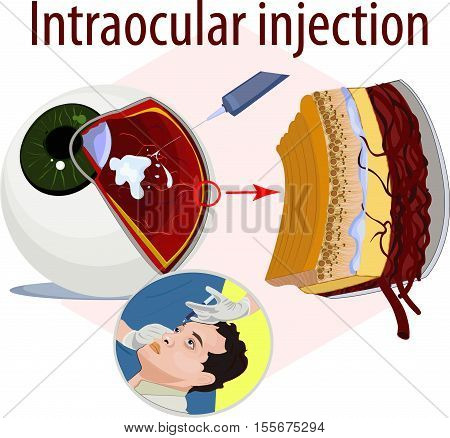 Vector illustration of intraocular injection science education