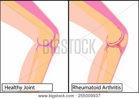 Healthy Knee Joint And Rheumatoid Arthritis Vector Illustration On A White Background