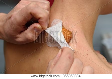 Replacing A Medical Bandage On A Postoperative Wound On The Girl's Neck