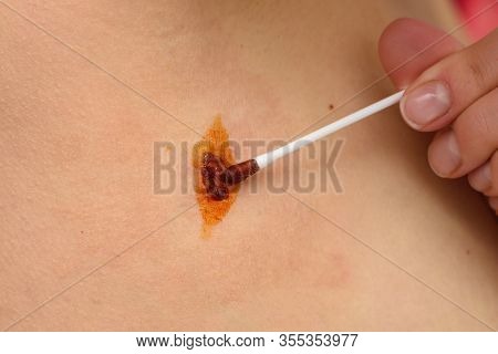 Antiseptic And Disinfectant Drug Based On Iodine Is Applied To The Wound With A Cotton Wand