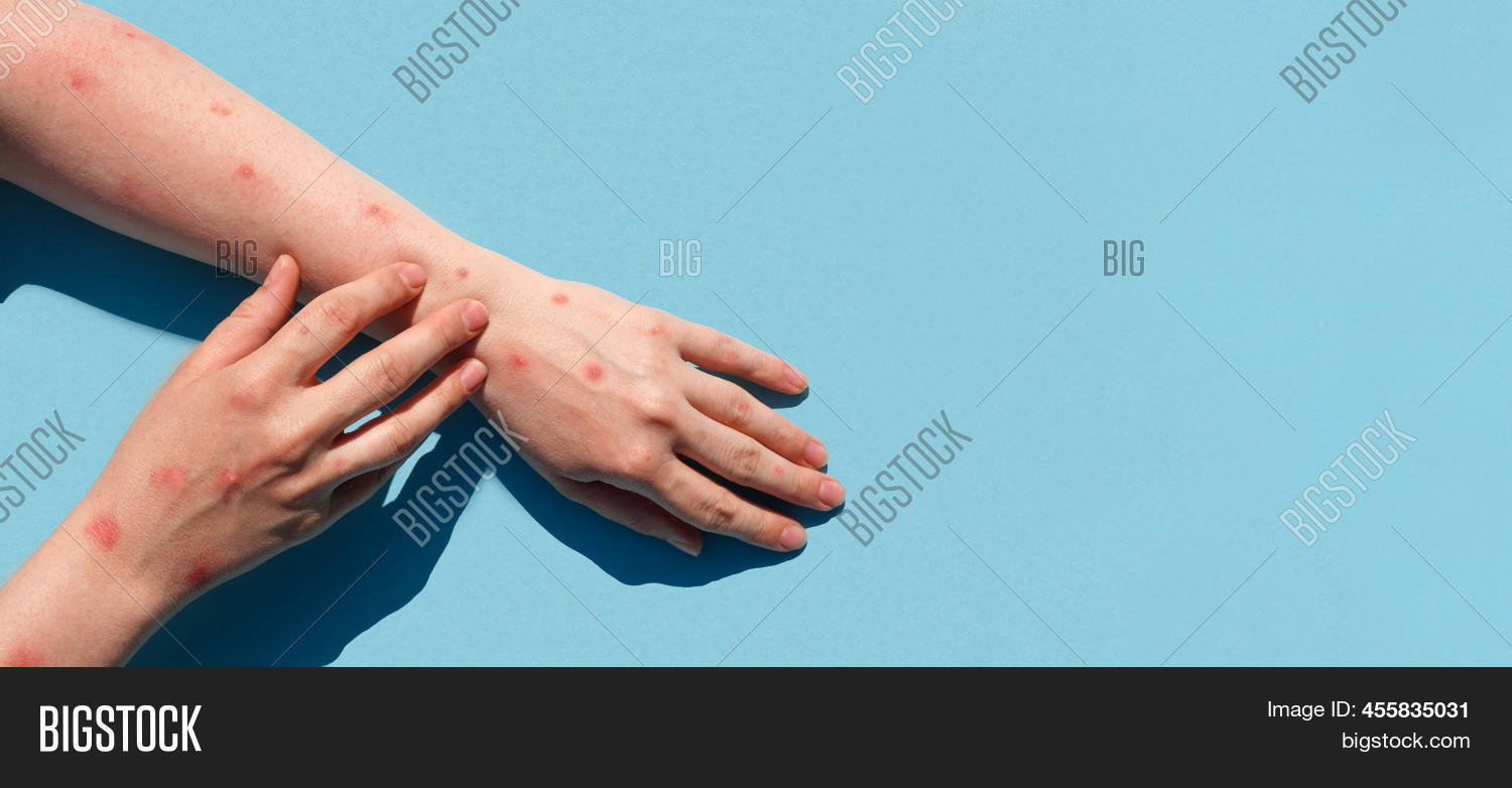 Monkeypox New Disease Image & Photo (Free Trial) | Bigstock