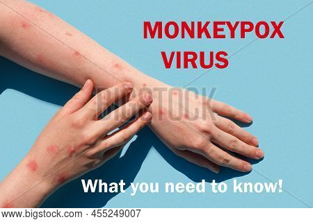 Phrase Monkeypox Virus What You Need To Know. Monkeypox New Disease Dangerous Over The World. Patien