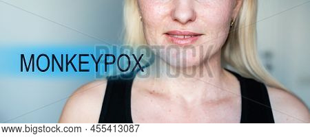 Woman Papules Face, Skin Texture Of Woman.