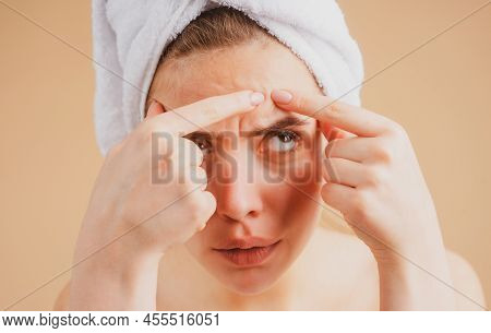 Close Up Woman Squeezing Pimples On Her Face. Acne Blemish Spots Skin On Young Woman. Spot Scar Acne