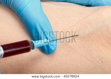 Blood Sampling With Syringe And Needle