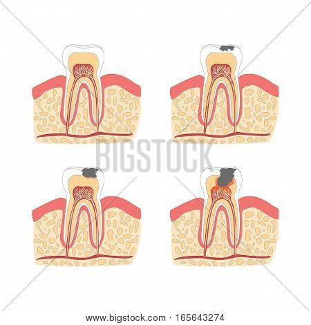 Cartoon Tooth with Stages of Dental Caries Formation Set Flat Design Style. Vector illustration
