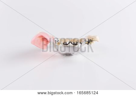 Clasp prosthesis with and attachments fixing ceramic crowns