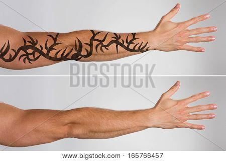 Attractive Man's Hand Before And After Laser Tattoo Removal Treatment