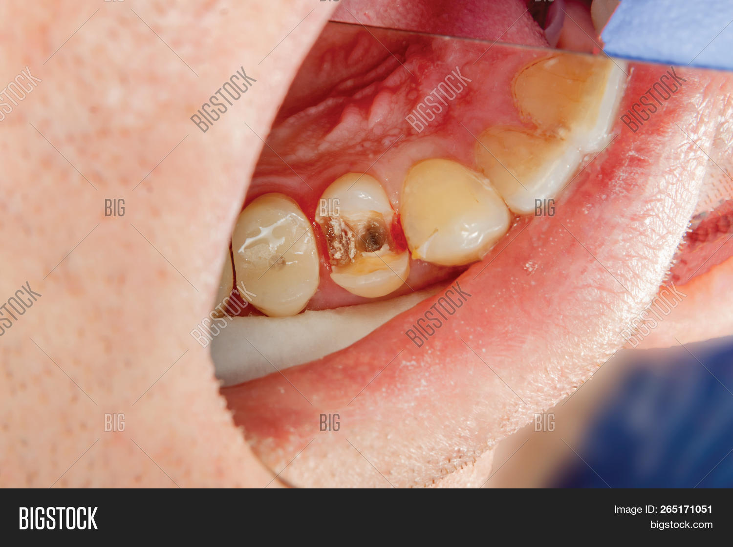 Two Chewing Side Teeth Image & Photo (Free Trial) Bigstock